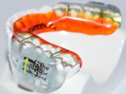 Types of Oral Appliances for Sleep Apnea Choosing the Right Fit