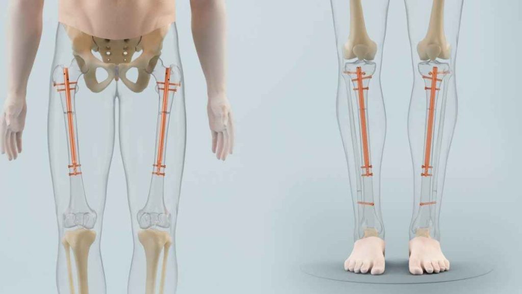 Insight into Limb Lengthening Indications, Procedures, Outcomes