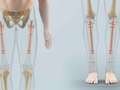 Insight into Limb Lengthening Indications, Procedures, Outcomes