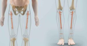 Insight into Limb Lengthening Indications, Procedures, Outcomes