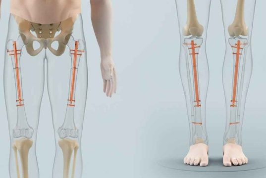 Insight into Limb Lengthening Indications, Procedures, Outcomes