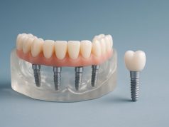 All on 4 dental implants at My Implant Dentist clinic in Melbourne dental surgery setting