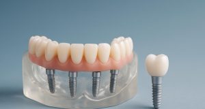 All on 4 dental implants at My Implant Dentist clinic in Melbourne dental surgery setting