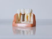 Dental Implant Prices in Hyderabad: A Complete 2026 Cost Breakdown