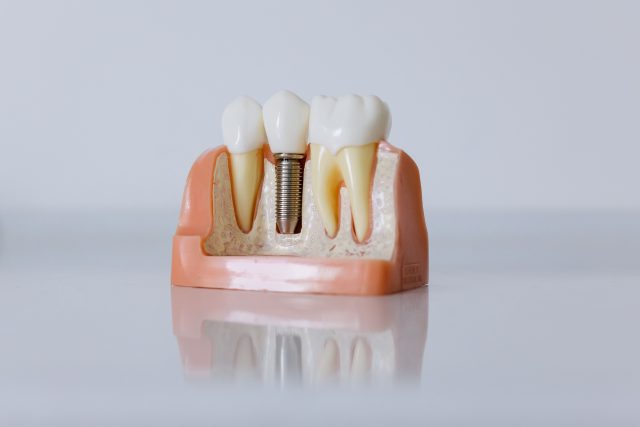 Dental Implant Prices in Hyderabad: A Complete 2026 Cost Breakdown